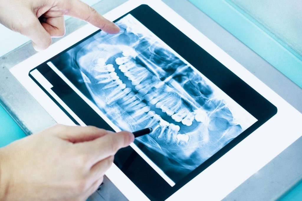 Understanding How Many Dental X-Rays Are Safe In A Month